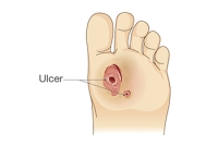 Preventing and Managing Diabetic Foot Ulcers