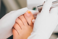 The Precise Nature of Laser Treatment for Fungal Nails